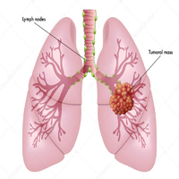 lung cancer-1